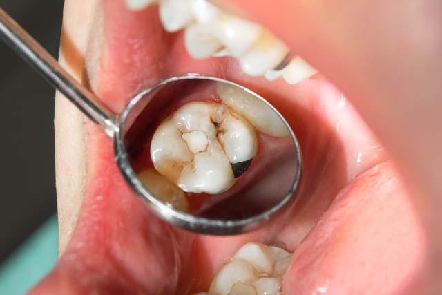 インビザラインは虫歯になりやすいの？