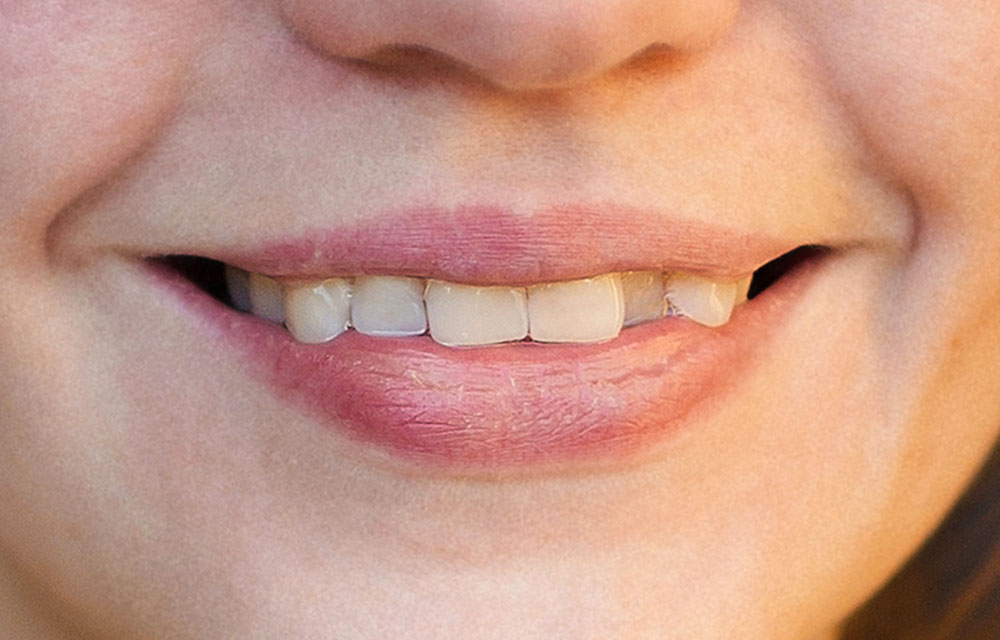 八重歯矯正のみのインビザライン(マウスピース矯正)